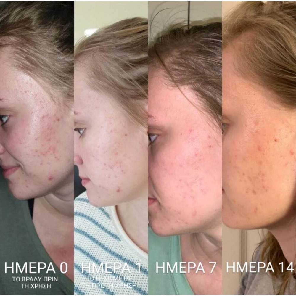 Bee Factor Κεραλοιφή Για Ακμή & Σπυράκια 40ml