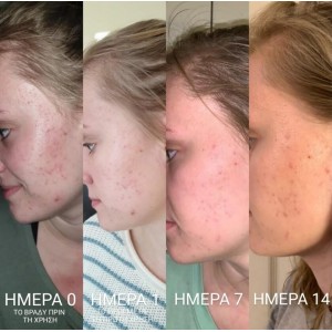 Bee Factor Κεραλοιφή Για Ακμή & Σπυράκια 40ml