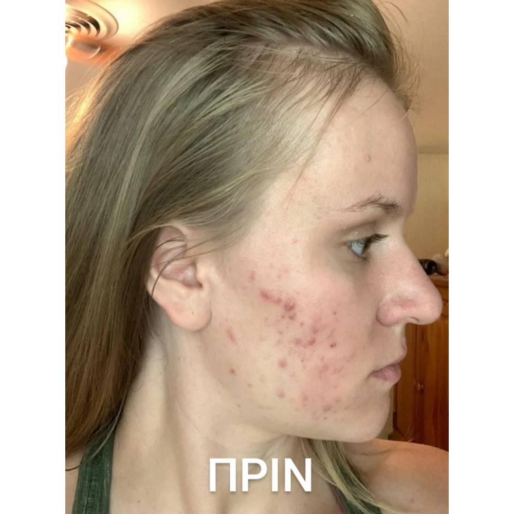 Bee Factor Κεραλοιφή Για Ακμή & Σπυράκια 40ml